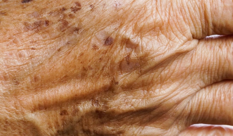 Yaşlılık Lekeleri: Doğal Çözümler ve Önlemler!